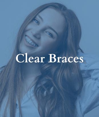 Clear Braces