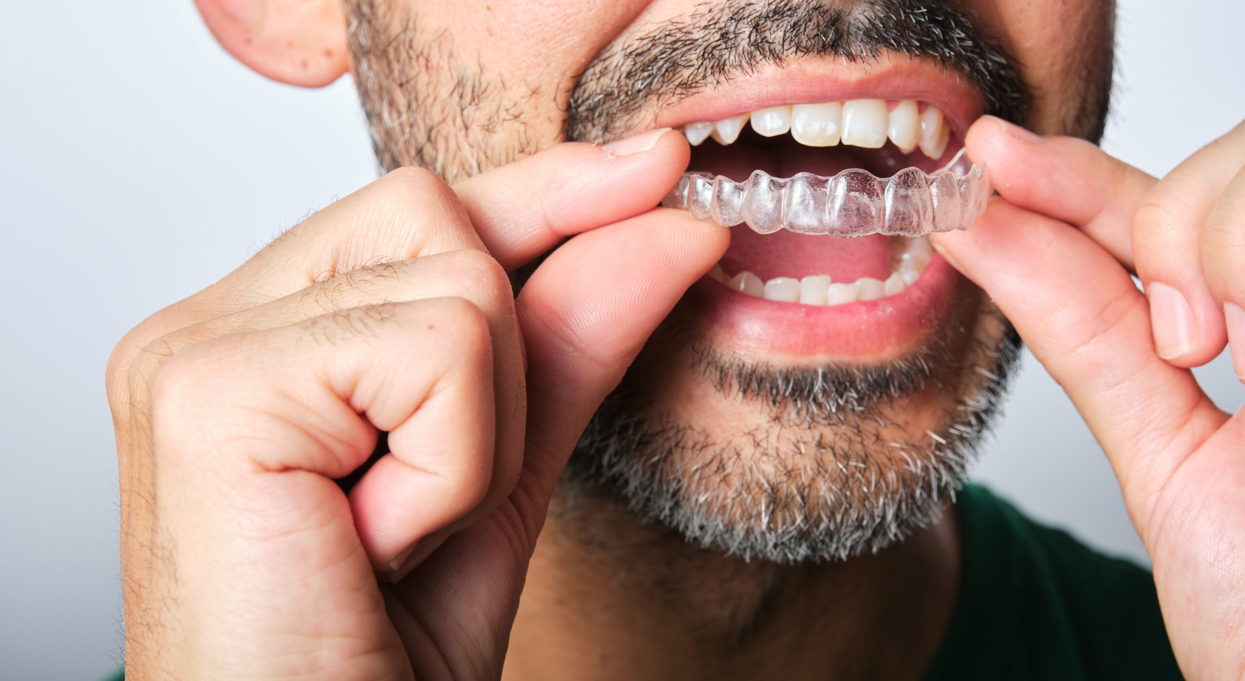 Aligners
