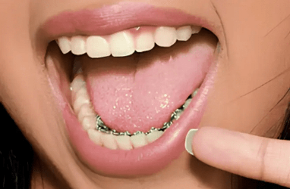 Lingual Braces