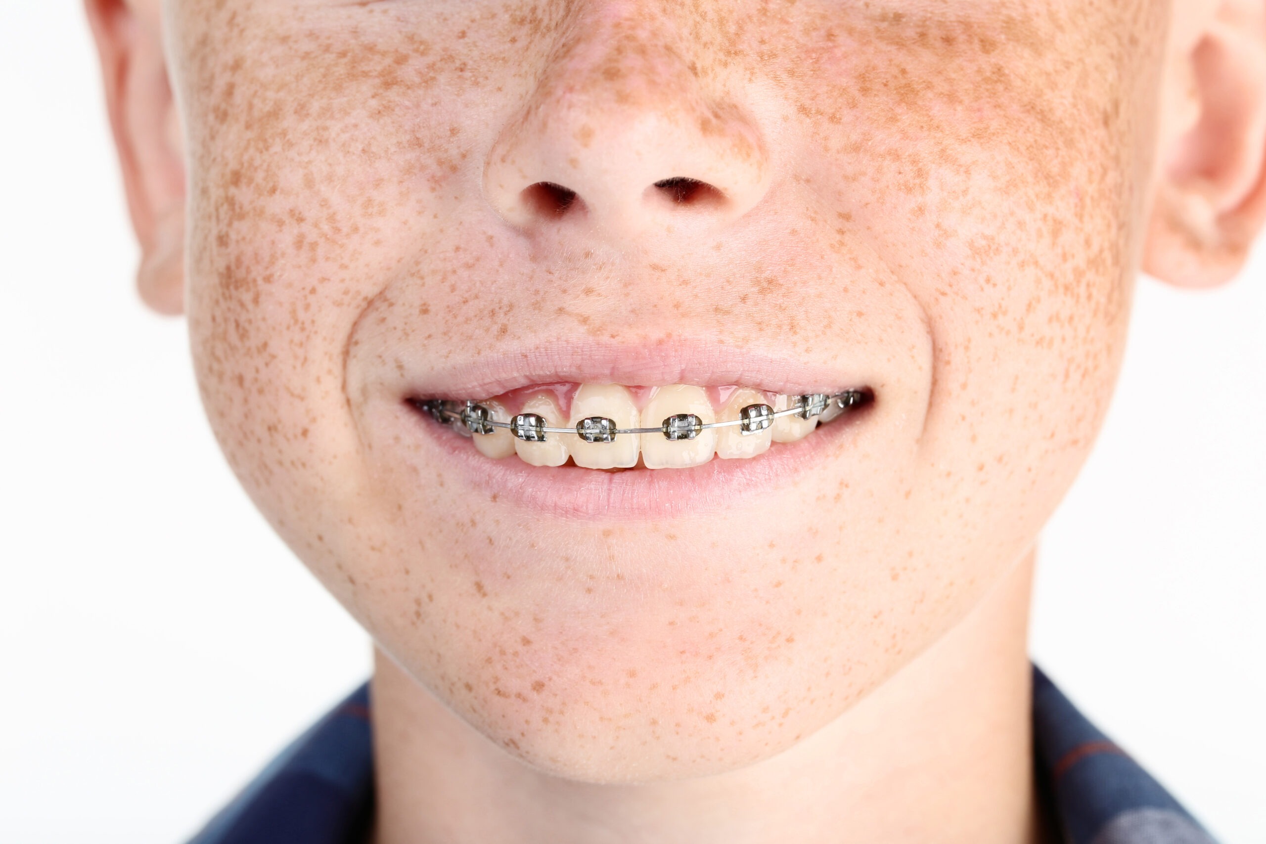 Traditional Braces