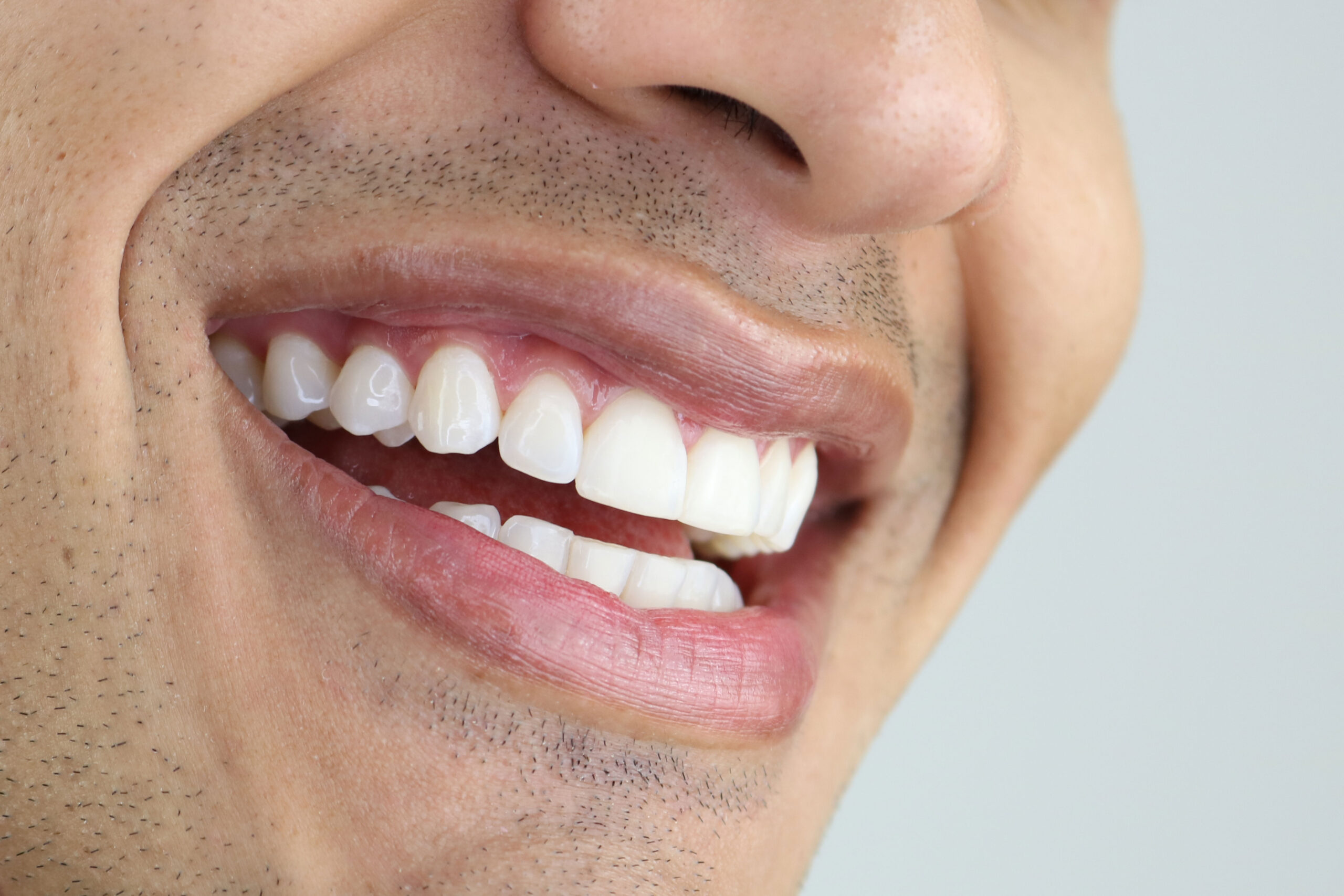 Whitening