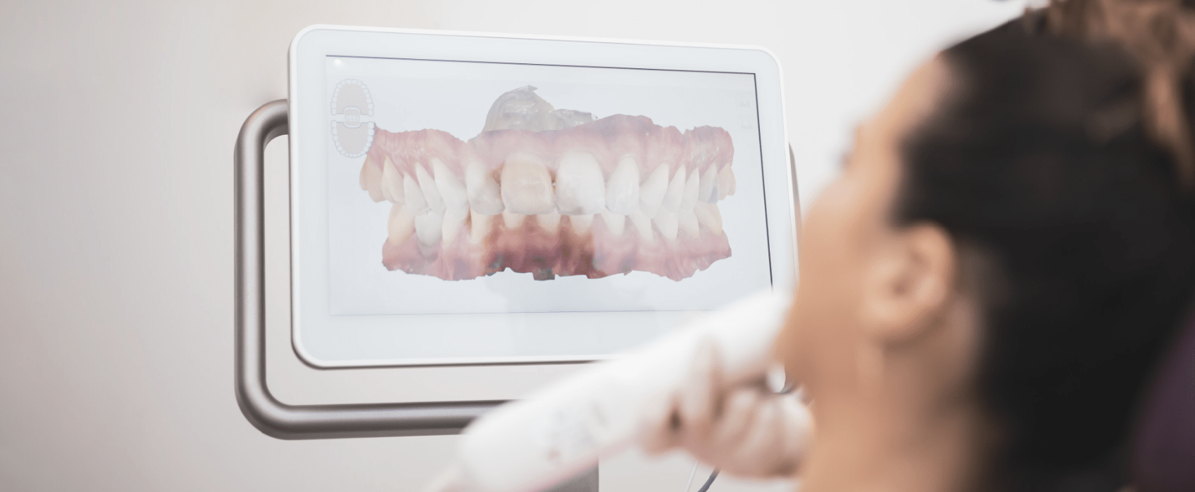 Preview Your New Smile with iTero Scanning